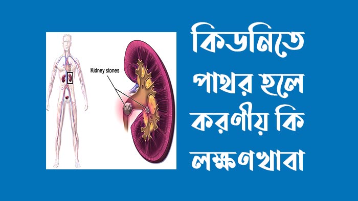 কিডনিতে পাথর হলে করণীয় কি